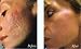 #1 TOP SELLING BRAND FOR CHEMICAL PEELS 50% Strength Pure Medical Grade Trichloroacetic Acid (Tca) Chemical Peel Solution