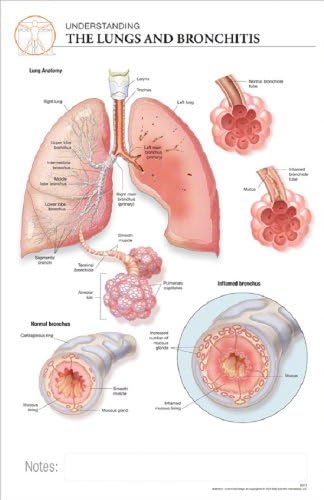 11 x 17 Post-It Disease Chart:Lungs & BRONCHITIS