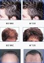 FORMALI Extra Strength #1 Natural Hair Growth Formula. 100% Herbal & Effective Pilatory for Men & Women. (ONE) Month Supply Treatment for Anti-Hair Loss. See Results Fast, Regrow new Hair within 2-4 weeks. See Visible Results in 3-4 months.