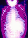 Babygram Normal Chest and Abdomen Photographic Poster Print, 30x40