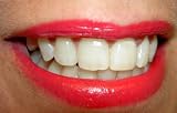 How to Whiten Teeth A-Z