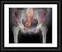Framed 10x8 Print (25x20cm) Uterine fibroid by Science Photo Library