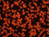Photomicrograph Sickle Cell Disease Rbc Genes Photographic Poster Print, 32x24