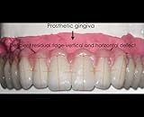 Protesi Fissa Ibrida in Zirconia - Nuovi Materiali e Protocolli