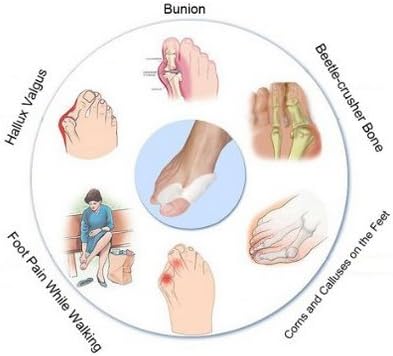 MyShine Bunion Relief - 2 Big Toe Protectors For Bunions Treatme / Gel Toe Separators / Spacers / Straightener / Spreader for Ease Foot Pain and Prevent Bunion Surgery