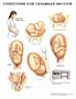 Conditions For Cesarean Section Anatomical Chart