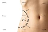 41uLAsRSNwL. SL160  Wallmonkeys Peel and Stick Wall Graphic   Female Waistline about to Perform Liposuction   24W x 16H