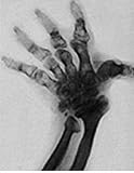 Genes and Disease - Muscle and Bone