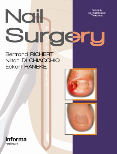 Nail Surgery (Series in Dermatological Treatment) On Sale