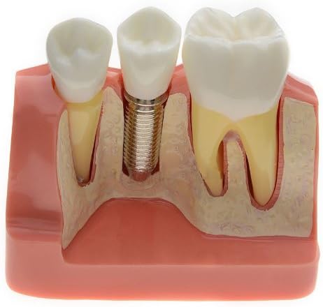 Simulation Implant Analysis Crown Bridge Demonstration Teeth Model Type
