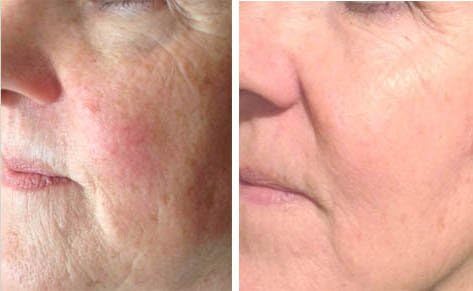 Strada21 Pure Anti Aging Serum.....Advanced! 21 Active Ingredients in ONE bottle with NO FILLERS. We Have Been Testing this Serum, with SUCCESS, for Over a Year. See the Dramatic RESULTS on a Few of Our Clients After Just a Few Weeks of Recommended Application! Strada21 is Fast Acting, Blends Age Spots , Smoothes Wrinkles, Tightens Skin and Stimulates Collagen. Dmae, Stem Cells, Peptides, PLUS, the latest, NEW Restorative Beauty Ingredients from Recent Laboratory Research! This Multi-Purpose Serum is the Latest in Facial Rejuvenation Products, with Excellent Results for all Women and Men who want to Achieve a Fresher Younger Look !