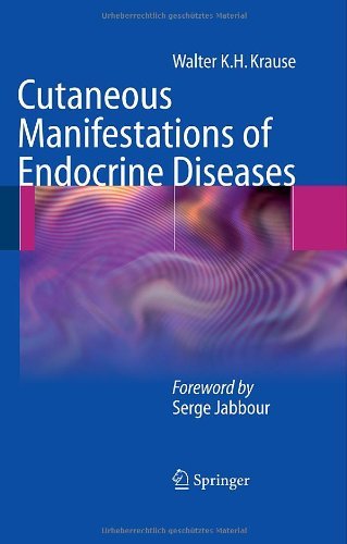 Cutaneous Manifestations of Endocrine Diseases