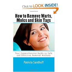 How to Remove Warts, Moles and Skin Tags: Your Comprehensive Guide to Safe and Effective... by Patricia Santhuff