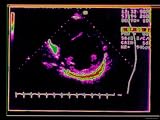 echocardiogram