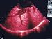 B-Color Echocardiogram Tricuspid Regurgitation Photographic Poster Print, 16x12