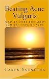 Beating Acne Vulgaris: How to cure the most common type of acne
