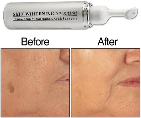 Skin Whitening Complex Removes Unsightly Blemishes