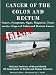 CANCER OF THE COLON AND RECTUM: Causes, Symptoms, Signs, Diagnosis, Treat-ments, Stages of Colon and Rectum Cancer- Revised Edition - Illustrated by S. Smith CANCER OF THE COLON AND RECTUM: Causes, Symptoms, Signs, Diagnosis, Treat-ments, Stages of Colon and Rectum Cancer- Revised Edition - Illustrated by S. Smith
