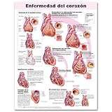 Heart Disease Anatomical Chart in Spanish (Enfermedad cardiaca) (Spanish Edition)