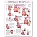 Heart Disease Anatomical Chart in Spanish (Enfermedad cardiaca)