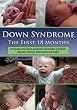 Down Syndrome: The First 18 Months