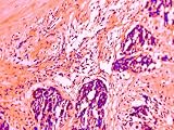 Malignant Mixed Tumor Breast Tissue Section Photographic Poster Print, 32x24