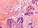 Malignant Mixed Tumor Breast Tissue Section Photographic Poster Print, 32x24