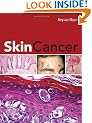 Skin Cancer