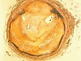 Photomicrograph Occluded Coronary Artery Show Plaque Build Up Photographic Poster Print, 40x30