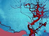 Blocked Vein Brain Burst Aneurysm Cerebral Blood Photographic Poster Print, 24x18