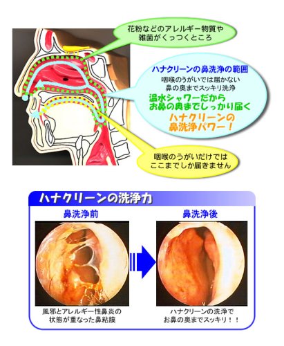 ハナクリーンEX