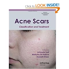 Acne Scars: Classification and Treatment (Series in Dermatological Treatment)
