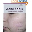 Acne Scars: Classification And Treatment (series In Dermatological Treatment)