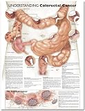 Understanding Colorectal Cancer Chart 510YDY6zTxL. SL160 Understanding Colorectal Cancer Chart