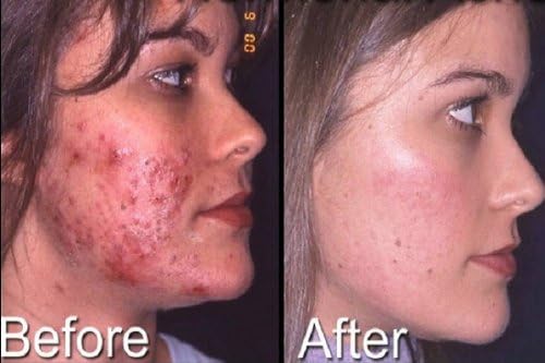 Retinol Vitamin A Cream .05% for Aging Acne Wrinkles Extra Large 30g Tube