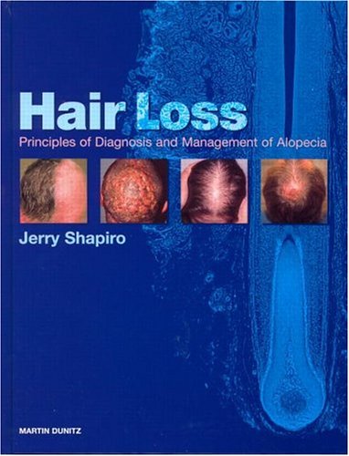 Hair Loss: Principles of Diagnosis and Management of Alopecia