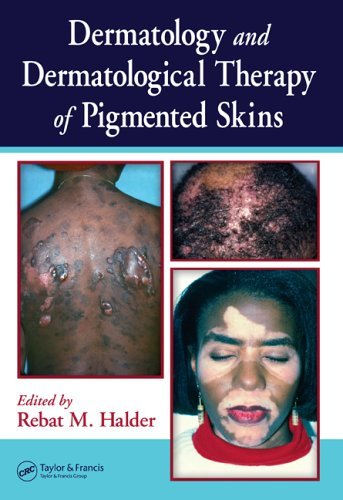 Dermatology and Dermatological Therapy of Pigmented Skins