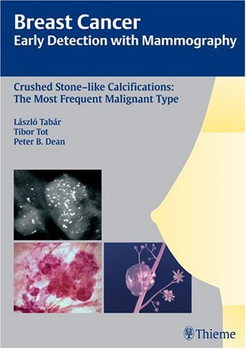 Crushed Stone-like Calcifications: The Most Frequent Malignant Type: Breast Cancer: Early Detection with Mammography