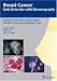 Crushed Stone-like Calcifications: The Most Frequent Malignant Type (Breast Cancer - Early Detection with Mammography)
