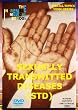 Sexually Transmitted Diseases STDs