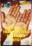 Sexually Transmitted Diseases (STDs)