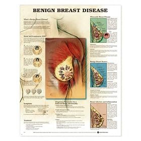 Benign Breast Disease Anatomical Chart Unmounted-9759PU by Anatomical Chart Company