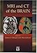 MRI and CT of the Brain