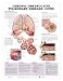 (20x26) Chronic Obstructive Pulmonary Disease COPD Anatomical Chart 2nd Edition Poster Print
