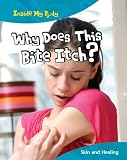 Why does this bite itch?