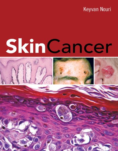 Skin Cancer On Sale