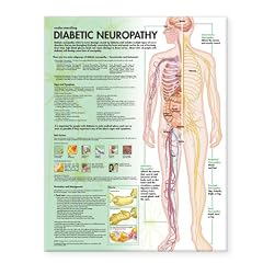Understanding Diabetic Neuropathy Anatomical Chart by Anatomical Chart Company