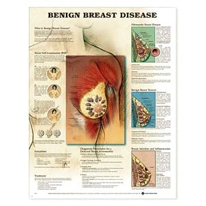 Chart - Benign Breast Disease by Lake Forest Anatomicals Female Health