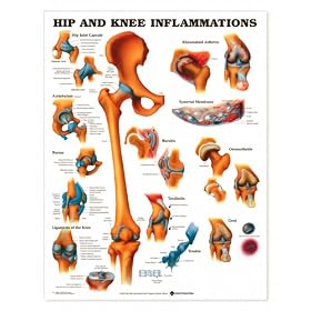 Hip and Knee Inflammations Anatomical Chart Laminated