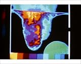 Photographic Print of Thermogram of varicocele in right of scrotum from Science Photo Library